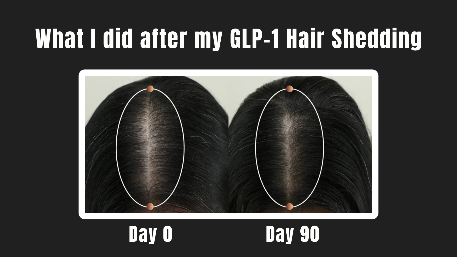 Illustration of a woman responding to increased hair shedding after starting a GLP-1