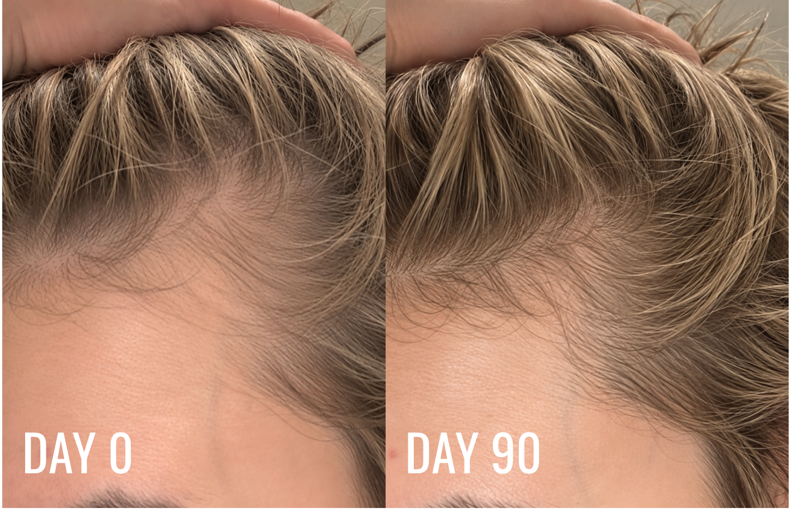 Hairline on day 0 compared with day 90 of RE:YOU Hair Revival Serum