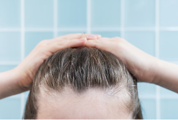 Greasy scalp from minoxidil formula