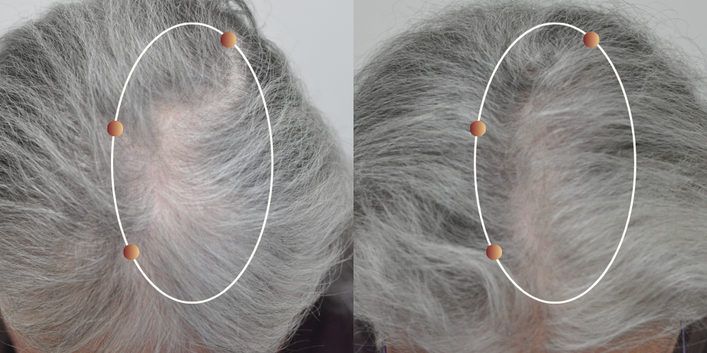 Crown area before and after 90 days of RE:YOU use
