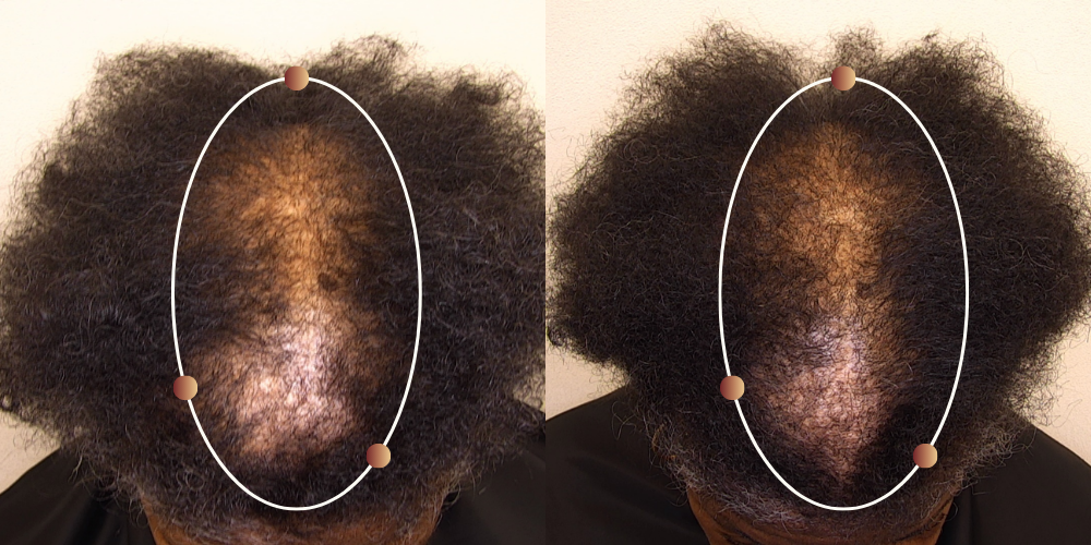 Diffuse thinning before and after 90 days of RE:YOU use