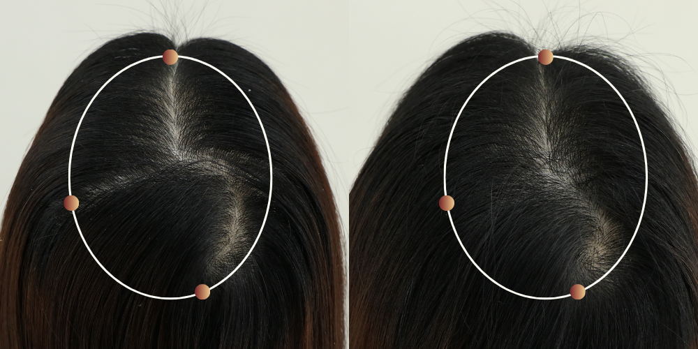 Mid-scalp area before and after 90 days of RE:YOU use